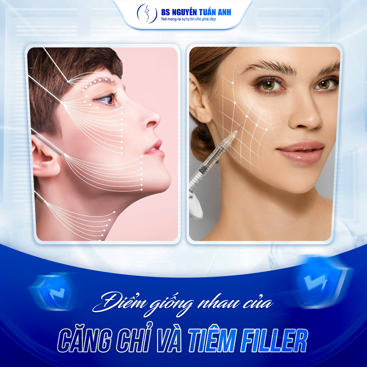 So Sánh Căng Chỉ Và Tiêm Filler